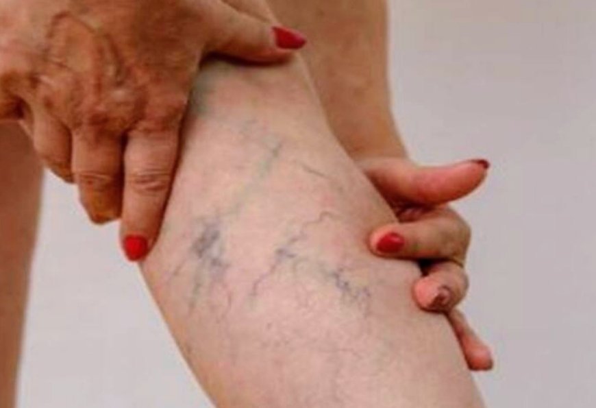 स्पाइडर वेन्स: पैरों की जाले जैसी नसें सेहत के लिए खतरा, जानें कारण और बचाव के तरीके