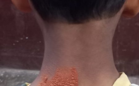 लखीमपुर खीरी: गोला में बंदरों का बढ़ता आतंक, 6 वर्षीय बच्चे पर हमला, बाल-बाल बची जान