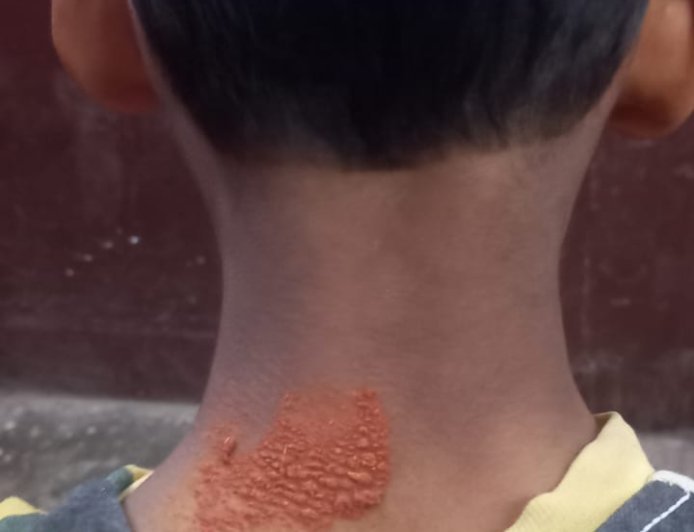 लखीमपुर खीरी: गोला में बंदरों का बढ़ता आतंक, 6 वर्षीय बच्चे पर हमला, बाल-बाल बची जान