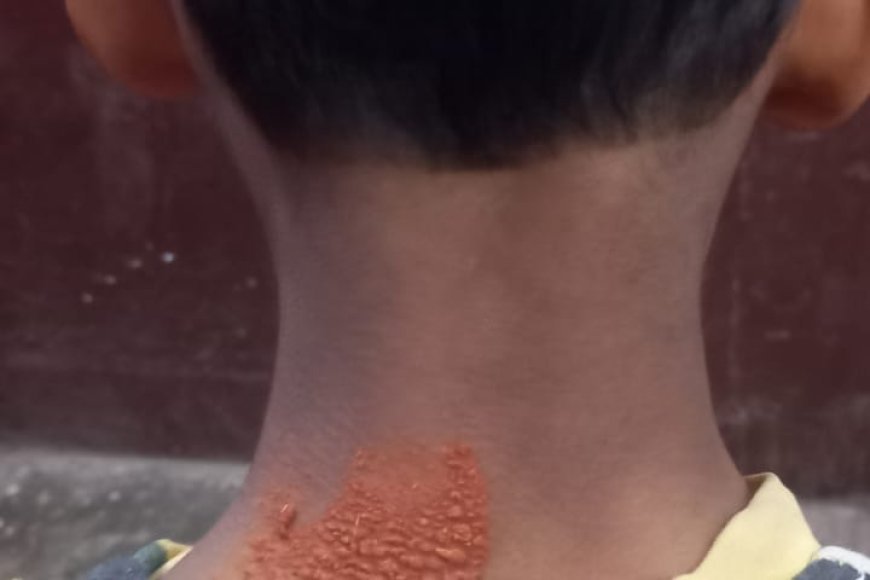 लखीमपुर खीरी: गोला में बंदरों का बढ़ता आतंक, 6 वर्षीय बच्चे पर हमला, बाल-बाल बची जान