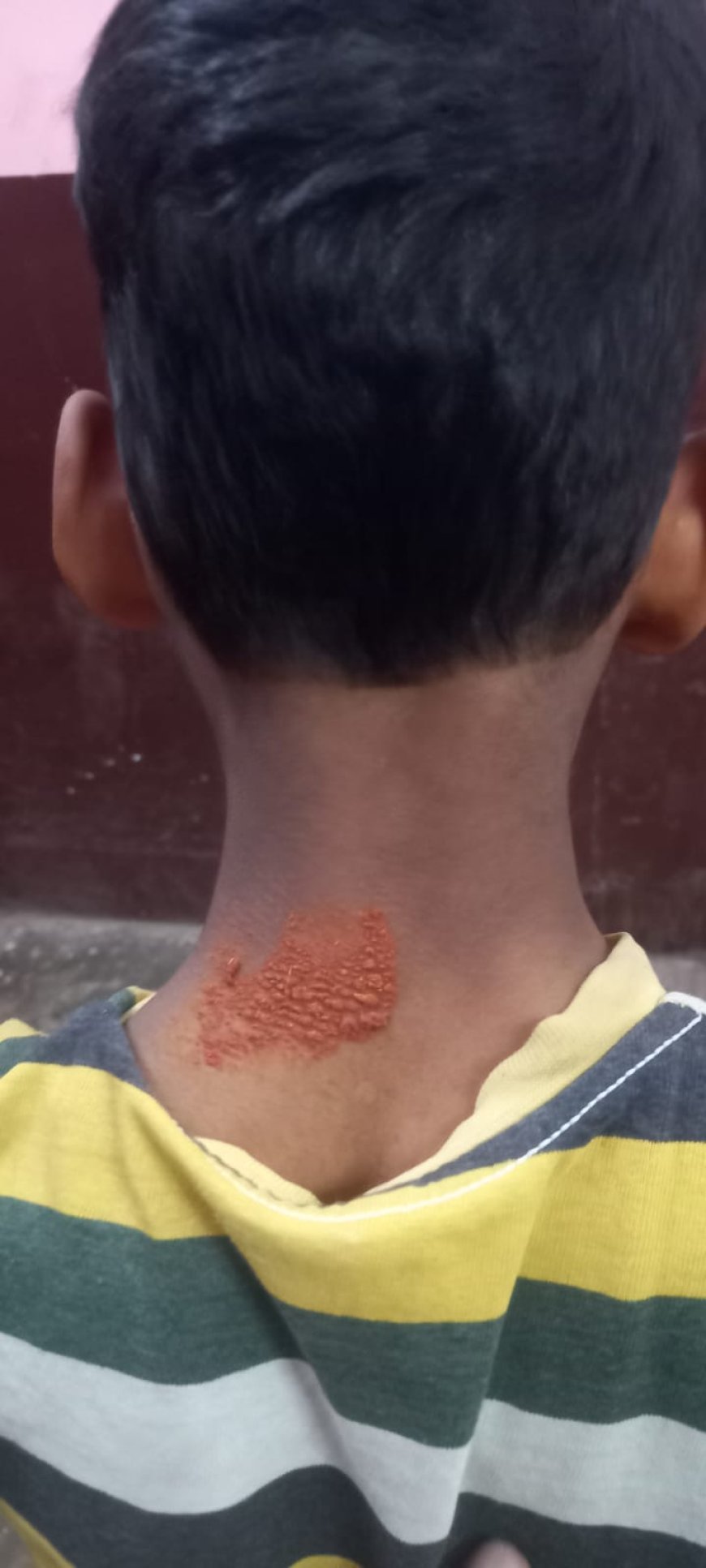 लखीमपुर खीरी: गोला में बंदरों का बढ़ता आतंक, 6 वर्षीय बच्चे पर हमला, बाल-बाल बची जान